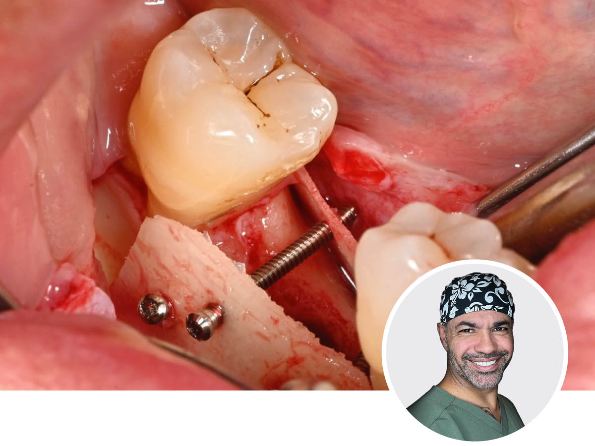 Großvolumige Knochenaugmentation | 26. - 27.06.2026 | München