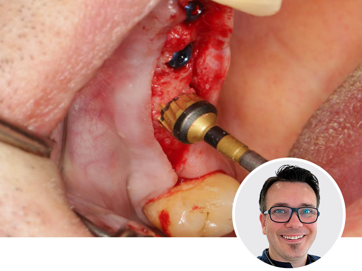 Digitale Implantologie mit Versah - für planbare und sichere Ergebnisse | 13.06.2026  | Frankfurt