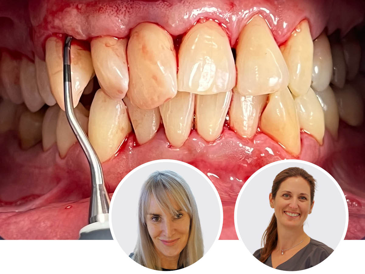 Parodontitis und ihre Wechselwirkungen