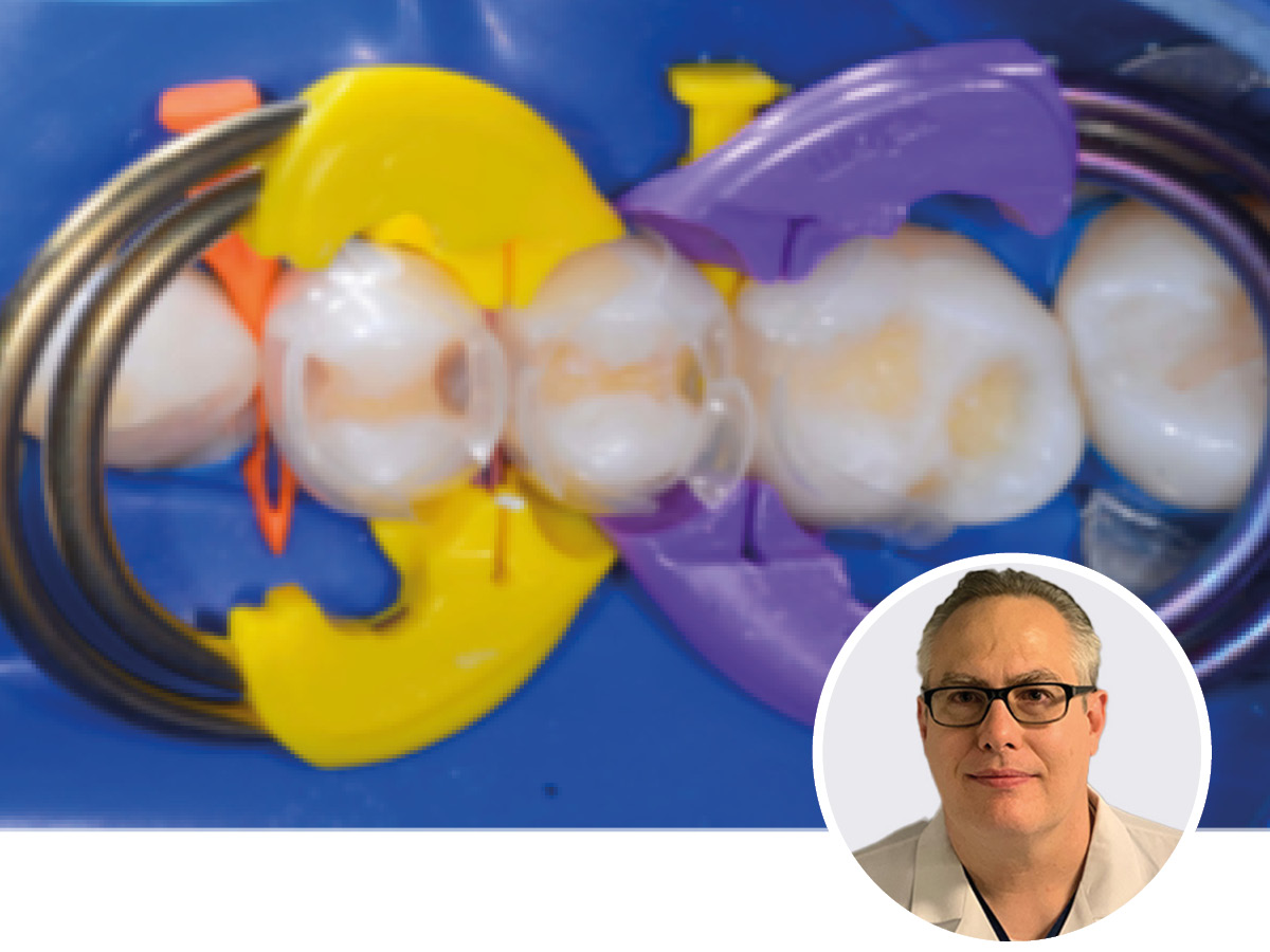 Effizient & ästhetisch: Komposit-Restaurationen mit vorgeformten Matrizen und der Injection-Molding-Technik | 12.-13.12.2025 | München