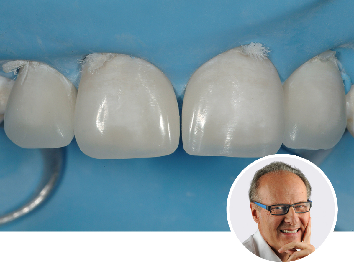 Ästh. Frontzahnrestaurationen -Theorie