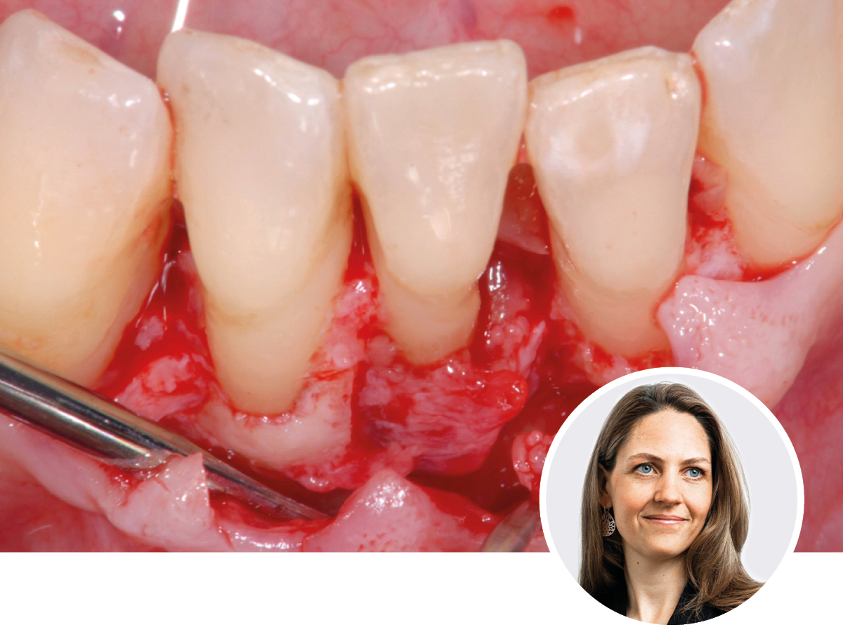 Regenerative Parodontitis-Therapie