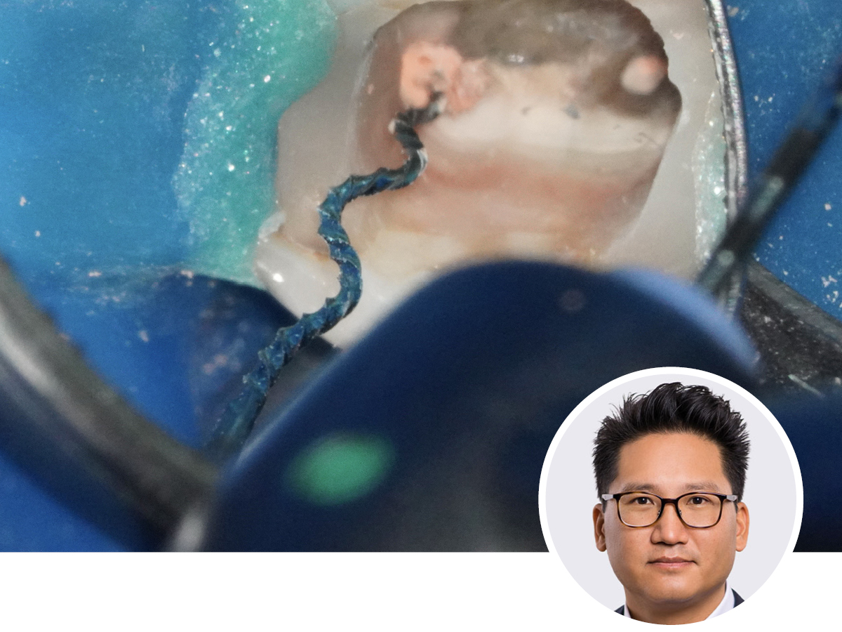 Mission Wurzelfüllung - Präzision bis ins Detail