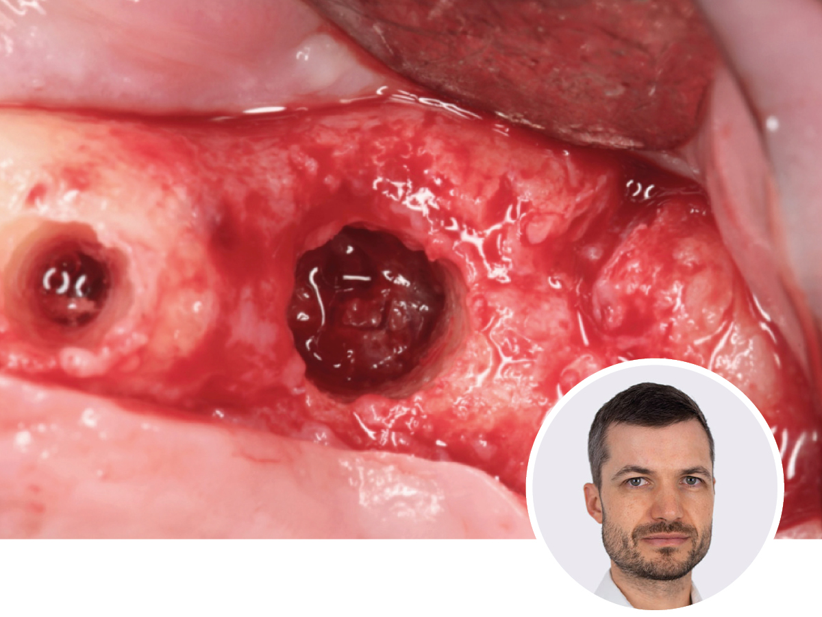 Osseodensification - Optimieren Sie Ihre Implantat-Präparation | 11.07.2026 | München