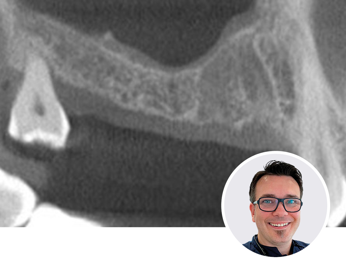 Optimierte Implantologie - Knochenmanagement für jede Situation  | 07.11.2026  | Hannover