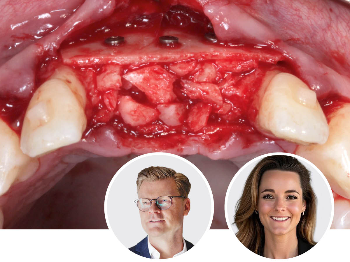 Knochenaugmentation in der Ästhetischen Zone