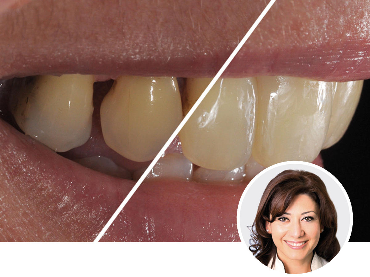 Hochästhetisches, nichtinvasives Veneering