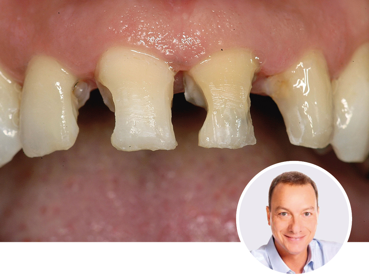 Adhäsive Restaurationen - an einem Wochenende