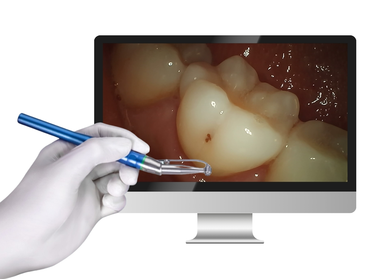 Apple-dental – 3in1 Micro Camera mit USB-C Adapter