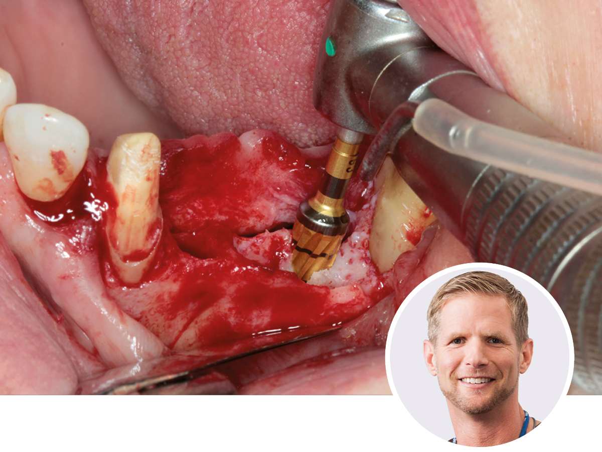 Modernes Knochenmanagement: Osseodensifikation & Augmentation | 09.05.2026 | Berlin