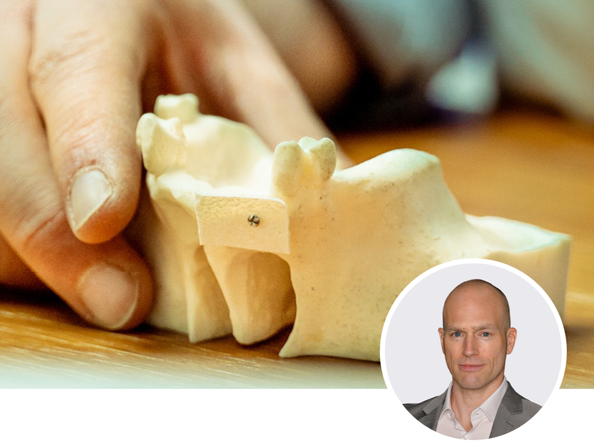 Osseodensification-Sofortimplantation