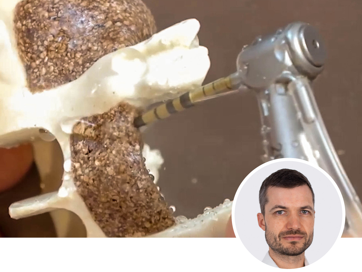 Osseodensification - GBR & sinuslift adé? | 22.04.2026