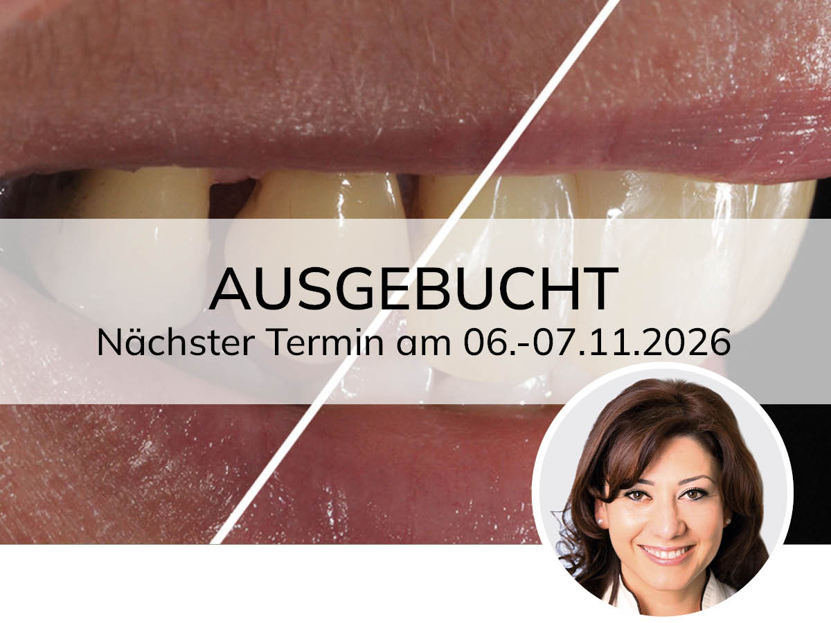 Hochästhetisches, nichtinvasives Veneering