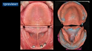 JB Tray Set (5x Ober-/ 5x Unterkiefer)